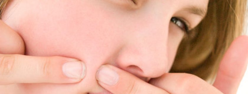 Como curar a acne de uma forma natural