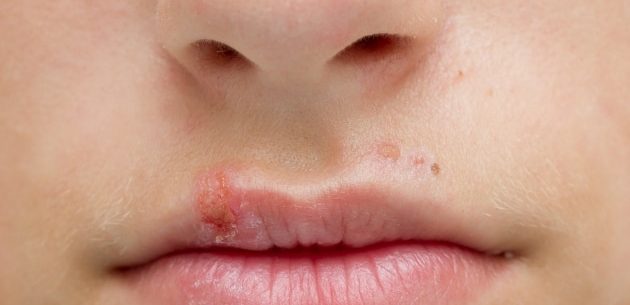 Remédios naturais para tratar a herpes labial