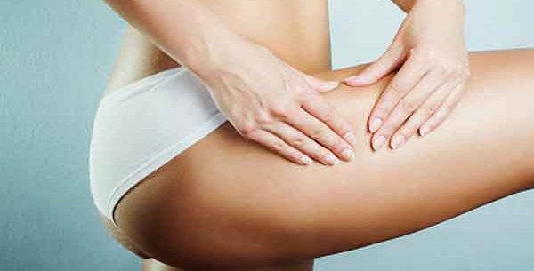 Dicas para prevenir as estrias