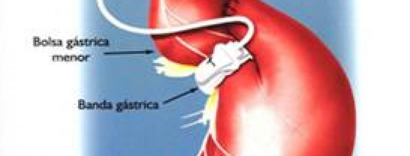 40% das pessoas que se submetem à cirurgia de redução de peso sofrem complicações