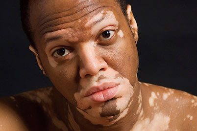 Remédios naturais para Vitiligo