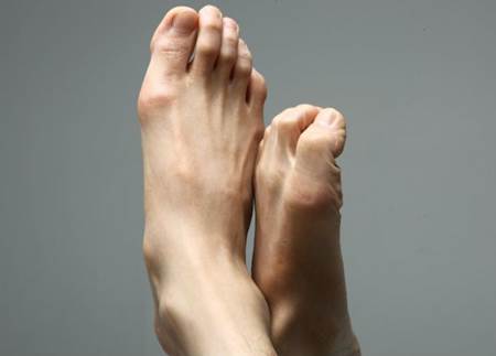 joanetes 1
