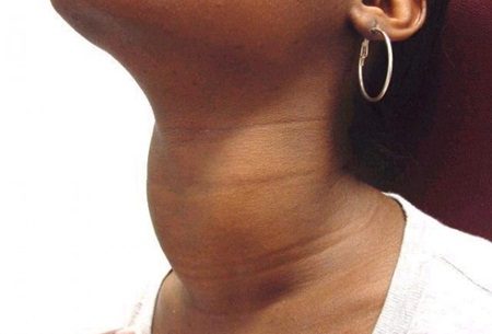 Tireóide: Hipertireoidismo e hipotireoidismo