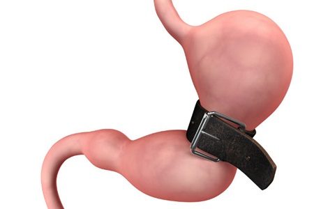 A cirurgia não é a solução mais fácil para a obesidade
