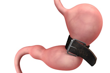 A cirurgia não é a solução mais fácil para a obesidade