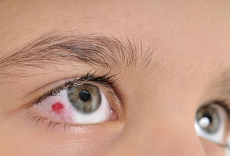 Pontos a considerar sobre os derrames oculares