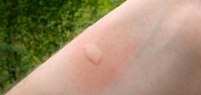 Luta contra mosquitos: como evitar e tratar picadas