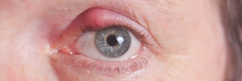 Terçol: o que é, como tratar e prevenir