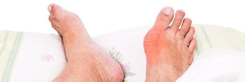 7 incríveis alimentos que ajudam a combater a gota naturalmente