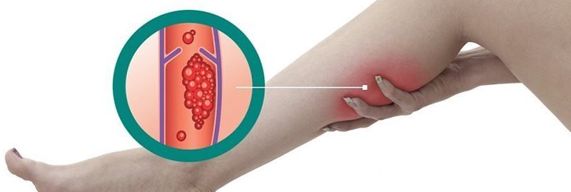 7 melhores remédios caseiros para trombose venosa profunda