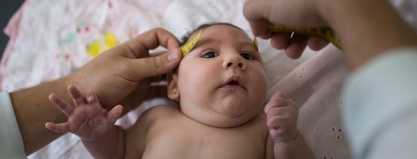 O que é microcefalia e quais suas consequências ao bebê