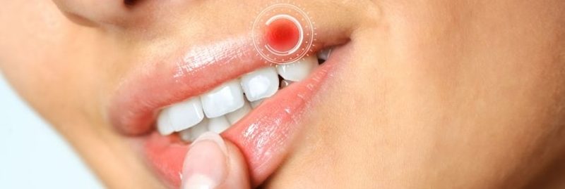 O que é o herpes e como tratá-lo em diferentes áreas do corpo