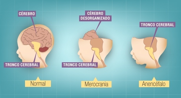 O que é anencefalia e como preveni-la