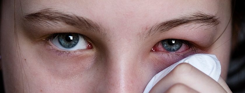 Conjuntivite: o que é, sintomas e tratamentos médicos ou caseiros