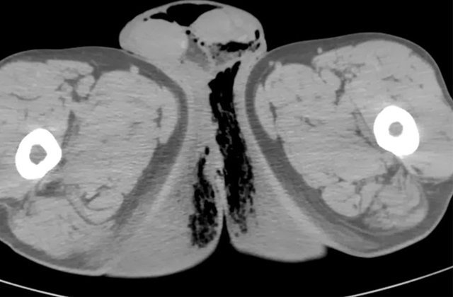 diagnostico da sindrome de fournier