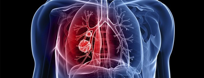 Enfisema pulmonar tem cura? Conheça seus sintomas e tratamentos