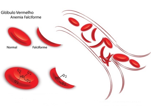 anemia falciforme