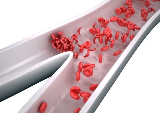 anemia falciforme