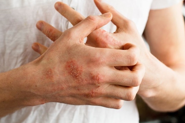 lupus