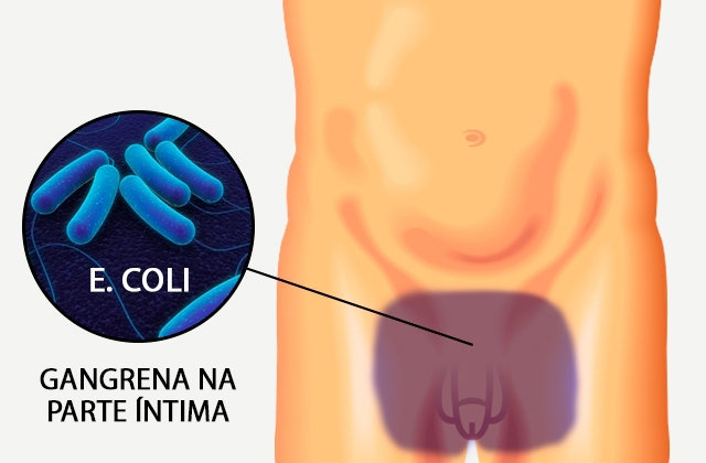 sintomas da sindrome de fournier