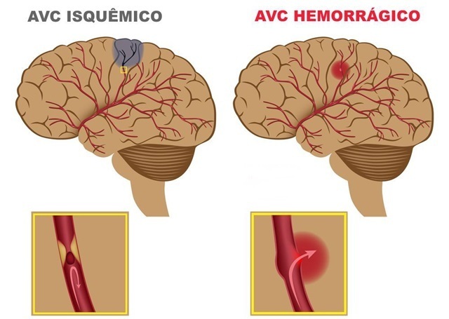 AVC