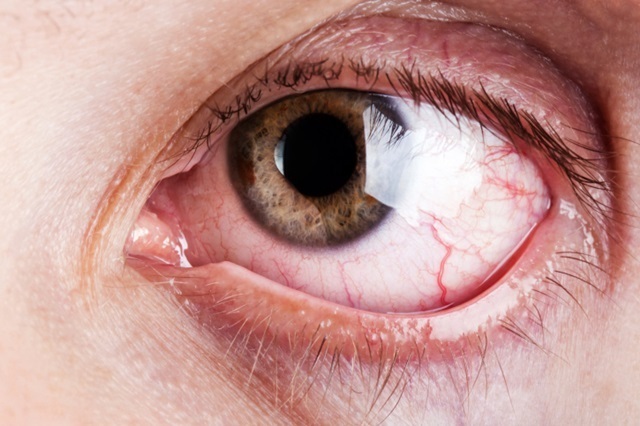 glaucoma