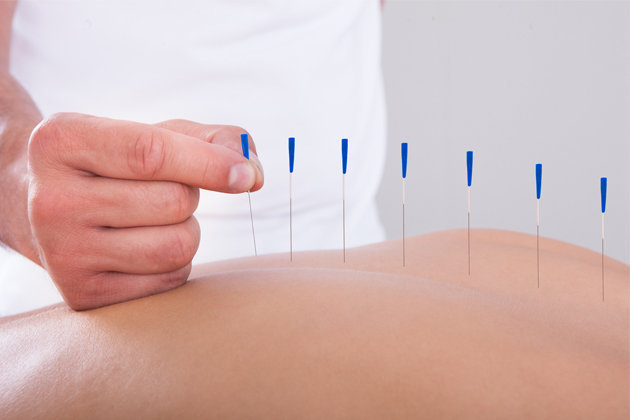 acupuntura