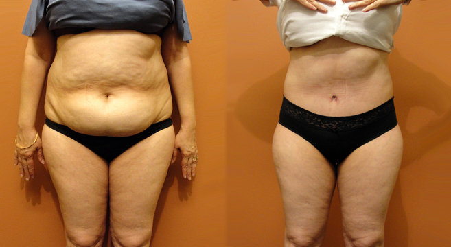 abdominoplastia