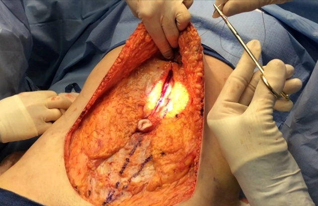 abdominoplastia