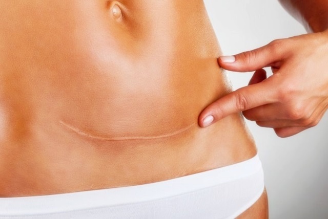 abdominoplastia