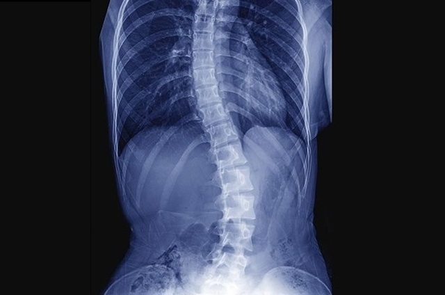 escoliose