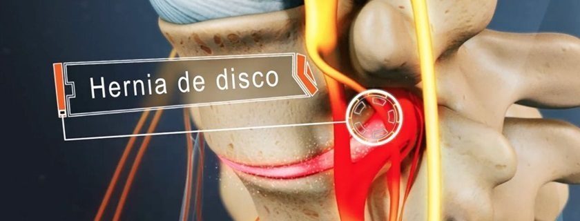 O que é hérnia de disco, quais seus sintomas e tratamentos?