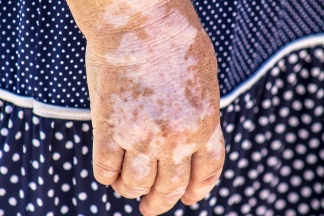 vitiligo