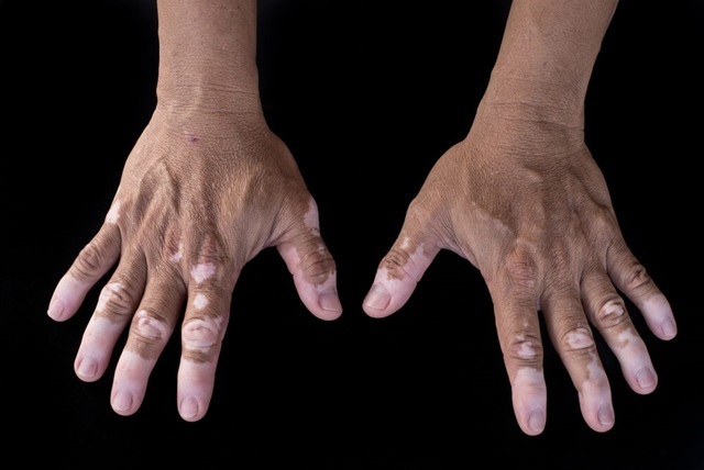 vitiligo