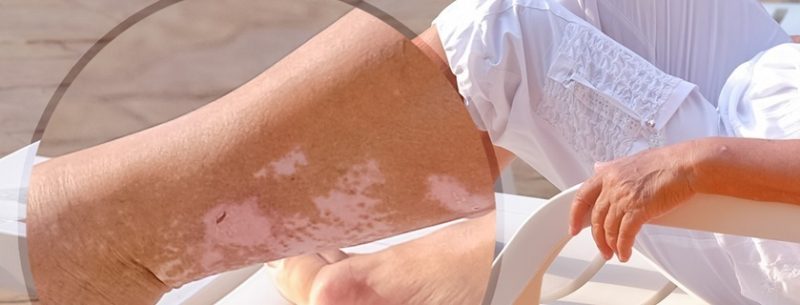 Vitiligo tem cura? Saiba o que é, suas causas, sintomas e tratamento