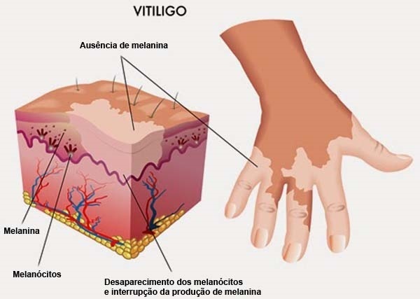 vitiligo